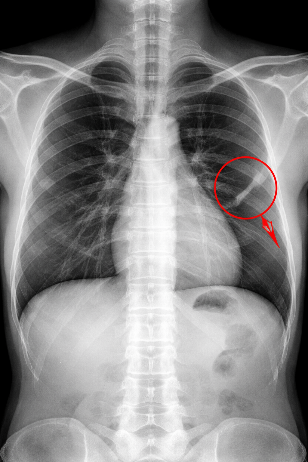Chest X-ray